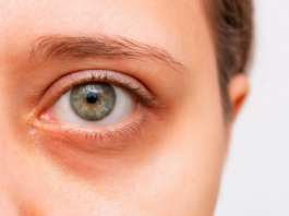 6 Remedios caseros para las ojeras | Menos invasivos remedios caseros para las ojeras