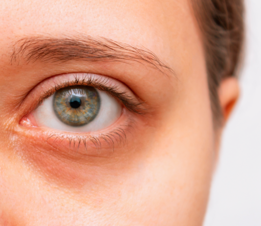 6 Remedios caseros para las ojeras | Menos invasivos remedios caseros para las ojeras