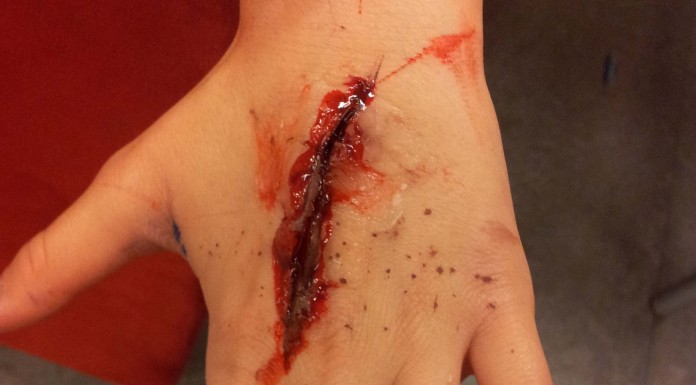 6 errores de primeros auxilios que son más peligrosos de lo que parece (II) 6 errores de primeros auxilios que son más peligrosos de lo que parece (II)