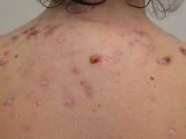 6 remedios caseros para combatir el acné 6 remedios caseros para combatir el acné