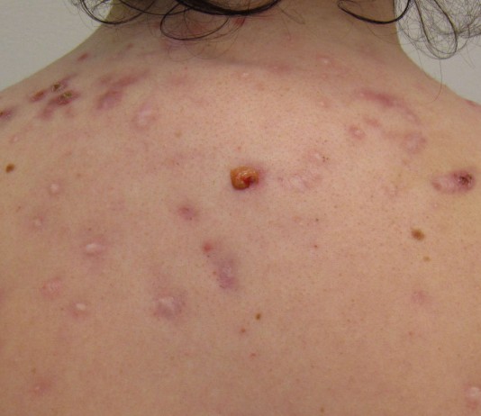 6 remedios caseros para combatir el acné 6 remedios caseros para combatir el acné