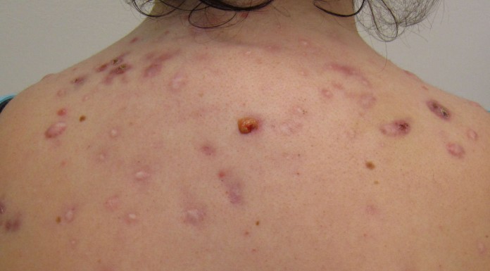 6 remedios caseros para combatir el acné 6 remedios caseros para combatir el acné