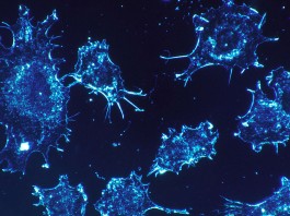 8 señales que pueden ser síntomas de algún cáncer 8 señales que pueden ser síntomas de algún cáncer