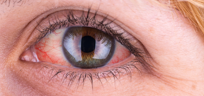 cómo curar los ojos rojos