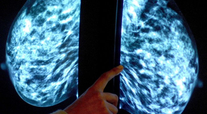 Un análisis de sangre podría ser suficiente para detectar el cáncer de mama Un análisis de sangre podría ser suficiente para detectar el cáncer de mama