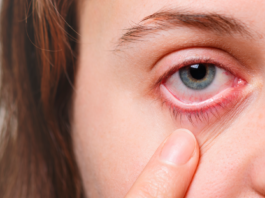 ¿Cómo curar los ojos rojos? | Remedios caseros infalibles cómo curar los ojos rojos