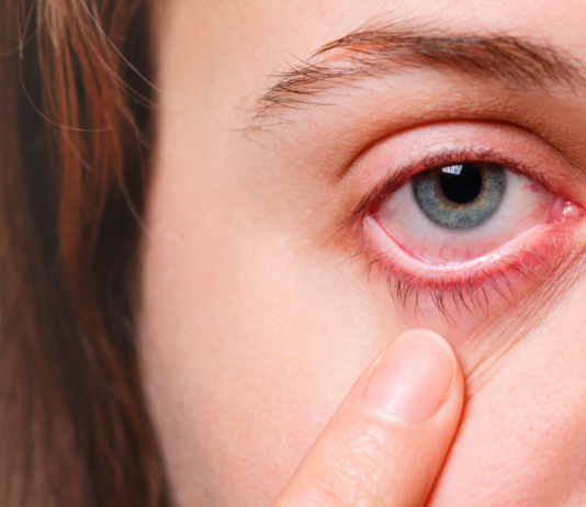 ¿Cómo curar los ojos rojos? | Remedios caseros infalibles cómo curar los ojos rojos