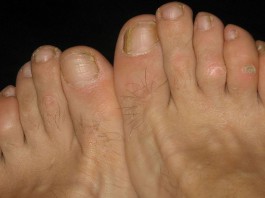 10 remedios caseros para los callos de los pies (I) 10 remedios caseros para los callos de los pies