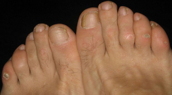 10 remedios caseros para los callos de los pies (I) 10 remedios caseros para los callos de los pies