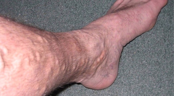 5 remedios caseros para aliviar el dolor causado por las varices 5 remedios caseros para aliviar el dolor causado por las varices