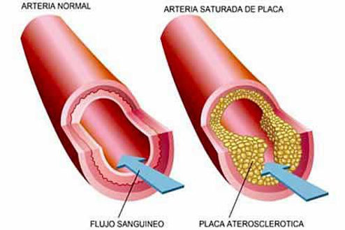 4 remedios caseros para limpiar las arterias y reducir el colesterol