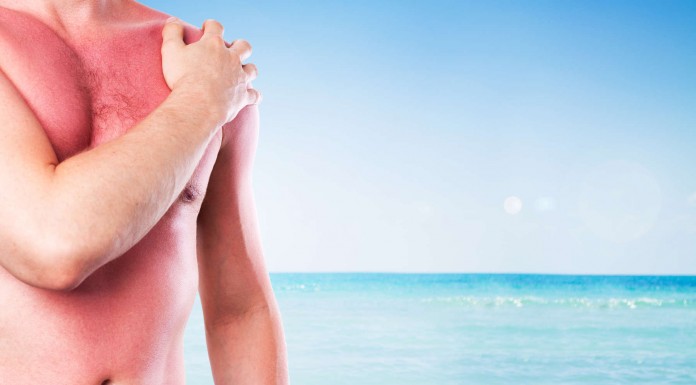 Cómo tratar las quemaduras solares Cómo tratar las quemaduras solares