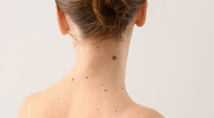 ¿Cómo saber si un lunar es maligno? | Conoce los diferentes tipos como saber si un lunar es maligno
