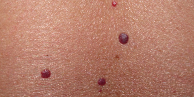 ¿Tener muchos lunares incrementa el riesgo de melanoma?