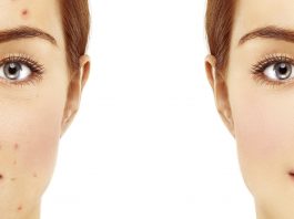 Remedios caseros para el acné