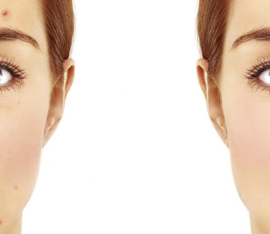 Remedios caseros para el acné