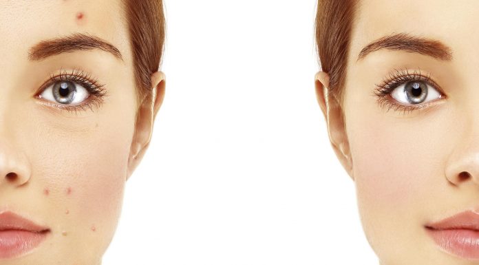 Remedios caseros para el acné