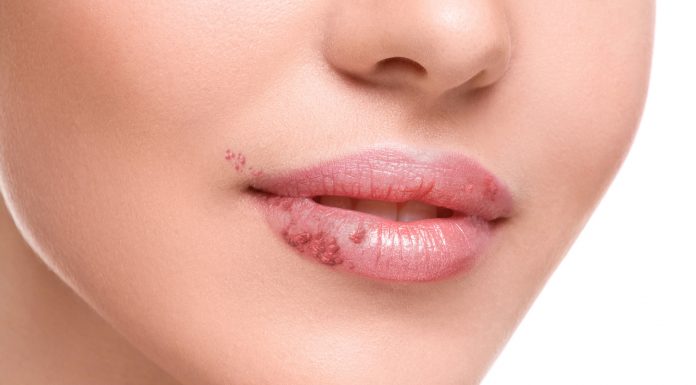 ¿Cómo eliminar un herpes labial de forma casera?