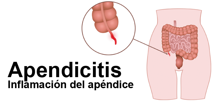 Síntomas de la apendicitis