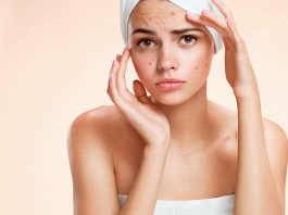 6 Remedios caseros para el acné: haz que desaparezca Remedios caseros para el acné