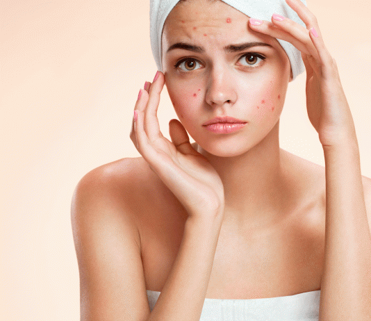 6 Remedios caseros para el acné: haz que desaparezca Remedios caseros para el acné