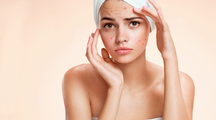 6 Remedios caseros para el acné: haz que desaparezca Remedios caseros para el acné