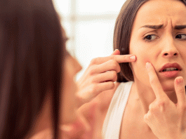 6 Remedios caseros para las espinillas. ¡Cómo evitarlas!