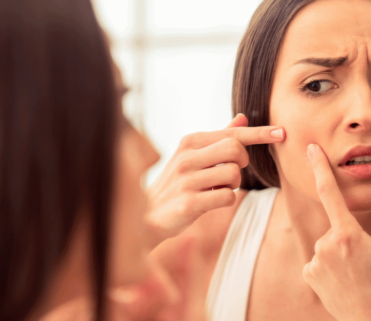 6 Remedios caseros para las espinillas. ¡Cómo evitarlas!