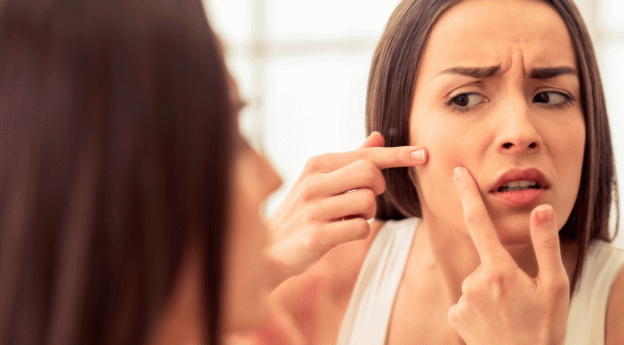 6 Remedios caseros para las espinillas. ¡Cómo evitarlas!