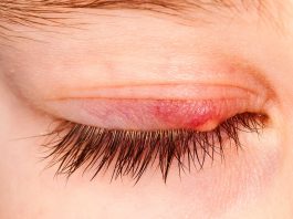 ¿Por qué salen los orzuelos? ¡Conoce sus causas! Por qué salen los orzuelos 1