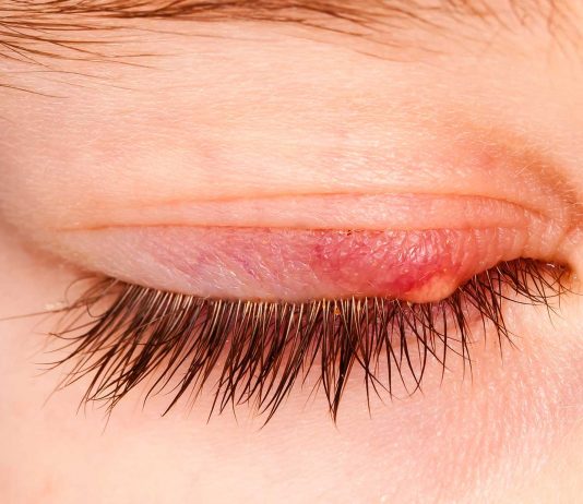 ¿Por qué salen los orzuelos? ¡Conoce sus causas! Por qué salen los orzuelos 1