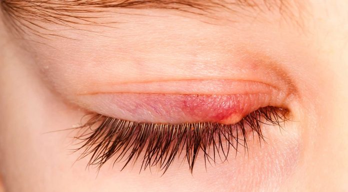 ¿Por qué salen los orzuelos? ¡Conoce sus causas! Por qué salen los orzuelos 1