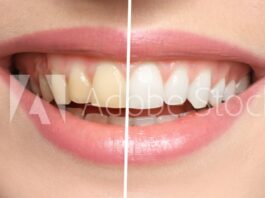 Mejora la higiene bucal haciendote un blanqueamiento dental