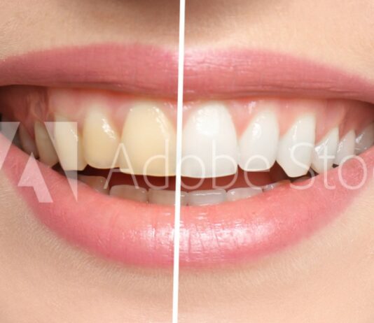 Mejora la higiene bucal haciendote un blanqueamiento dental