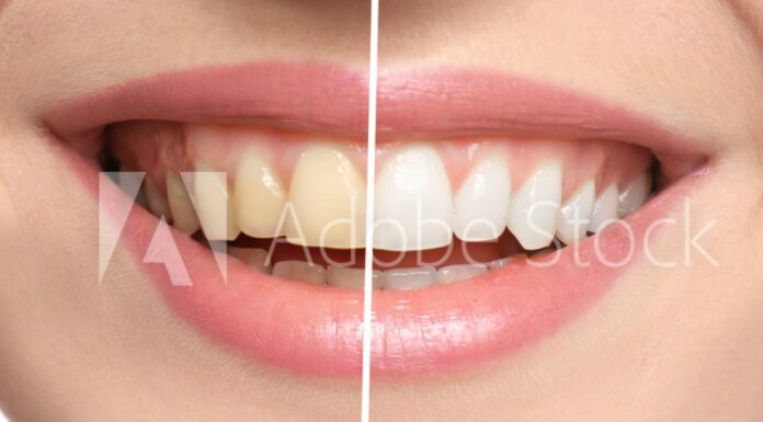 Mejora la higiene bucal haciendote un blanqueamiento dental