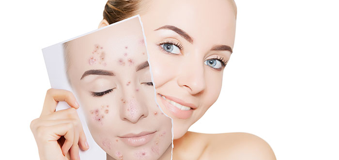 Cuáles son las principales recomendaciones para eliminar el acné facial 2
