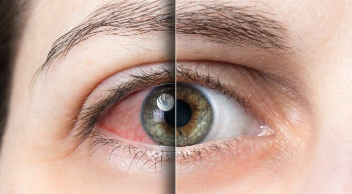 ¿Qué es la Queratitis Herpética? Todo lo que necesitas saber ¿Qué es la Queratitis Herpética? Todo lo que necesitas saber