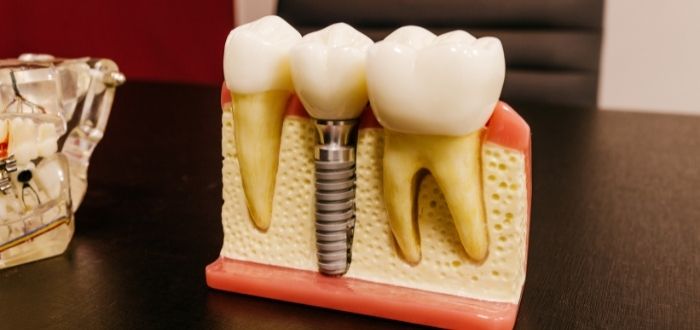 Implantes Dentales: qué son y qué tipos existen