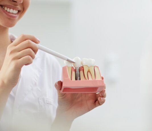 Implantes Dentales: ¿Es posible recuperar la sonrisa en 24 horas?