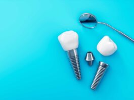 Implantes dentales: ¿son la solución para ti? implantes dentales