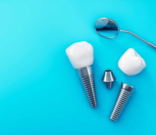 Implantes dentales: ¿son la solución para ti? implantes dentales