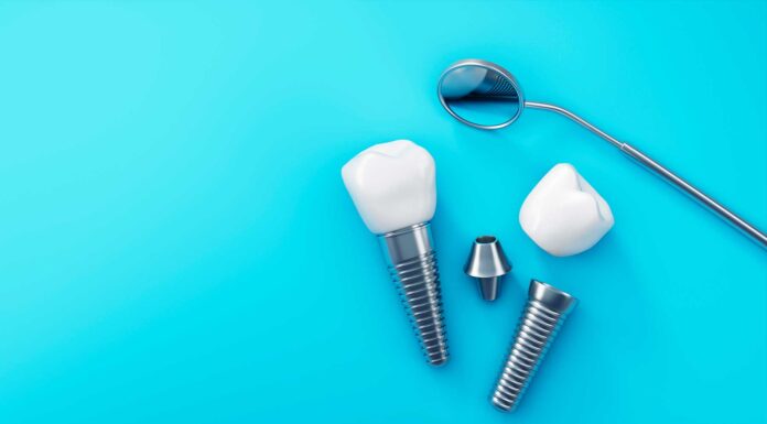 Implantes dentales: ¿son la solución para ti? implantes dentales