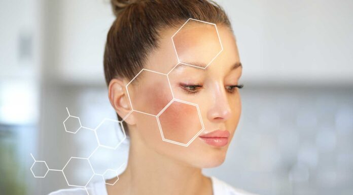 melasma