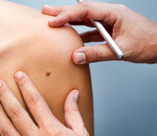 Melanoma y cáncer de piel: prevención, síntomas y tratamiento Melanoma y cáncer de piel