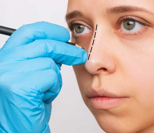 5 consejos para la recuperación después de una rinoplastia 5 consejos para la recuperación de una rinoplastia