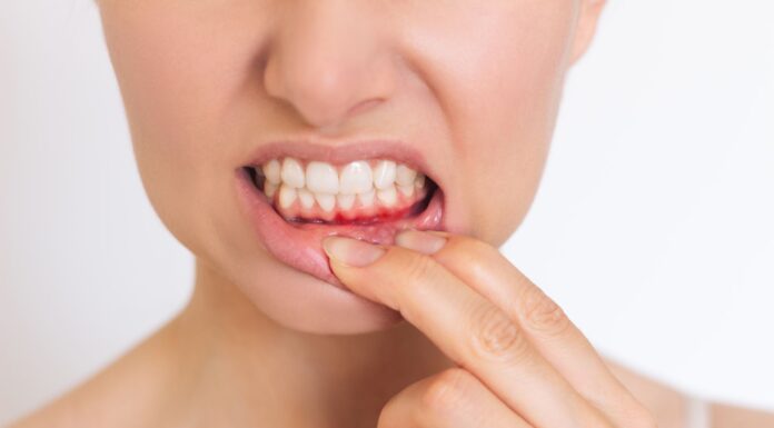 ¿Cómo curar la gingivitis? | Remedios y tratamientos cómo curar la gingivitis