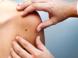 Consejos para prevenir el melanoma: Recomendaciones y tratamiento Consejos para prevenir el melanoma