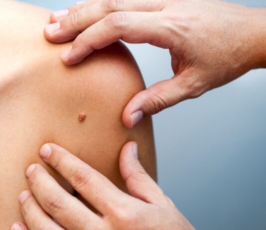 Consejos para prevenir el melanoma: Recomendaciones y tratamiento Consejos para prevenir el melanoma