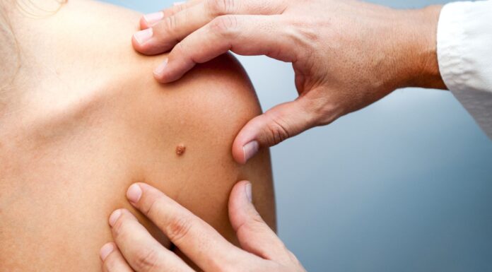 Consejos para prevenir el melanoma: Recomendaciones y tratamiento Consejos para prevenir el melanoma