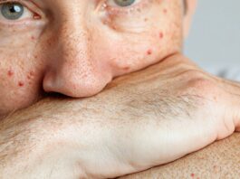 ¿Qué es la queratosis pilaris? | Cómo prevenirla y tratarla qué es la queratosis pilaris